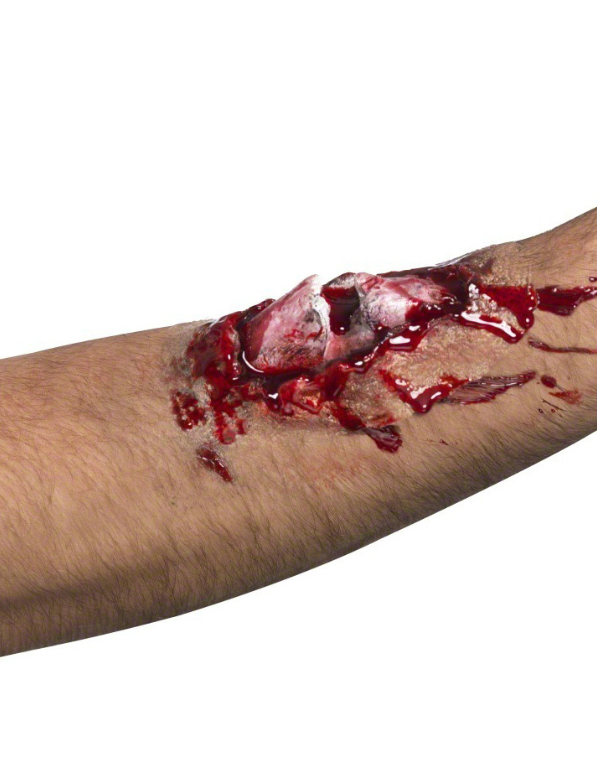 Fausse blessure os cassé